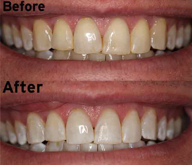 Laser Teeth Whitening - Review & Pics - Dr Kosinski DDS ...